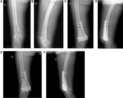 Case report: Cholesterol granuloma of femur